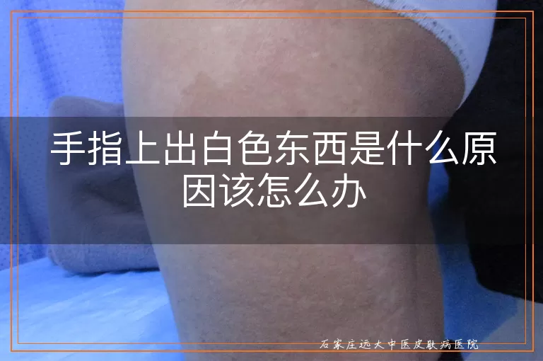 手指上出白色东西是什么原因该怎么办