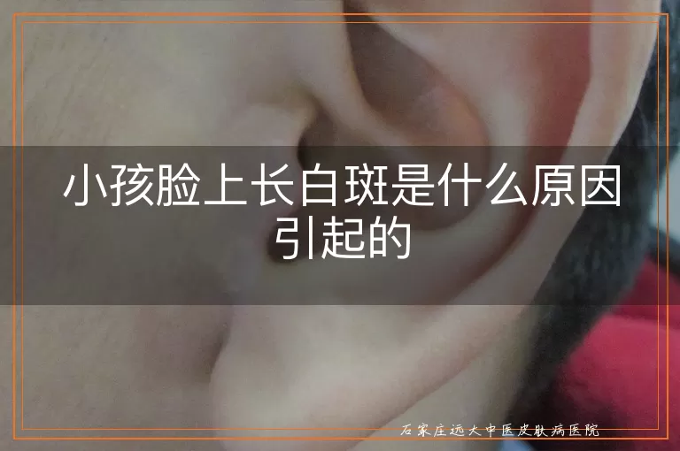 小孩脸上长白斑是什么原因引起的