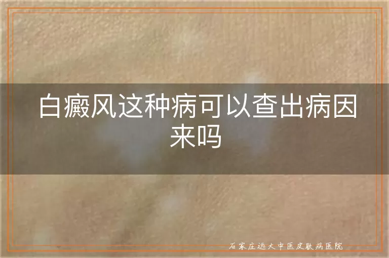 白癜风这种病可以查出病因来吗