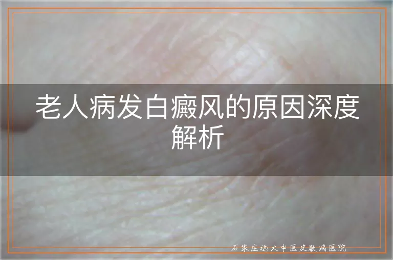 老人病发白癜风的原因深度解析