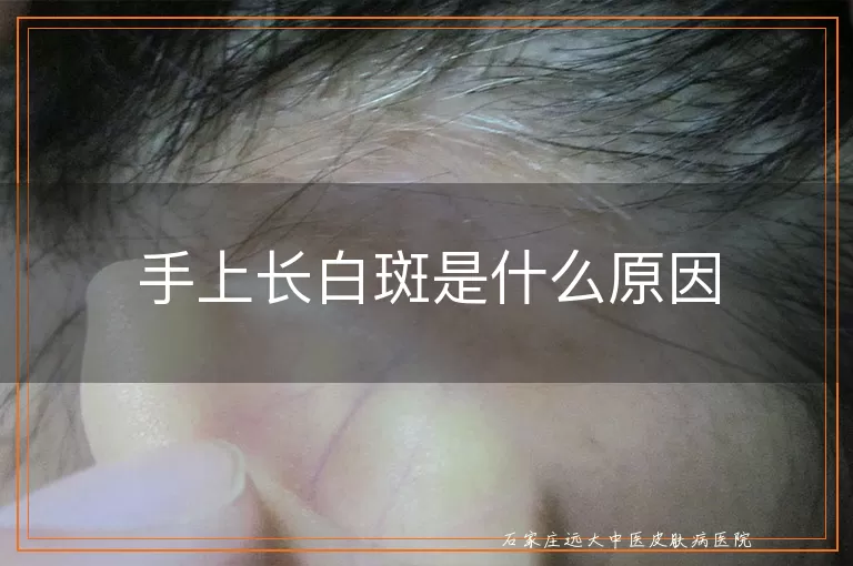 手上长白斑是什么原因