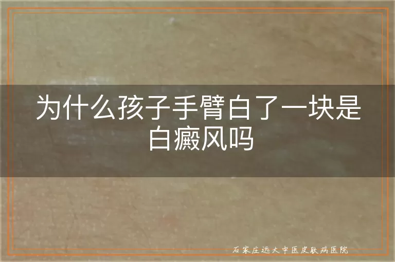 为什么孩子手臂白了一块是白癜风吗