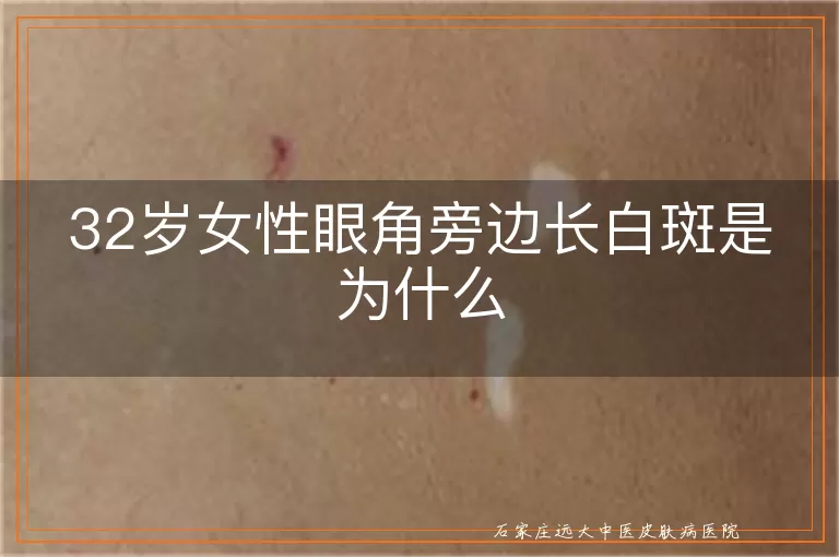 32岁女性眼角旁边长白斑是为什么