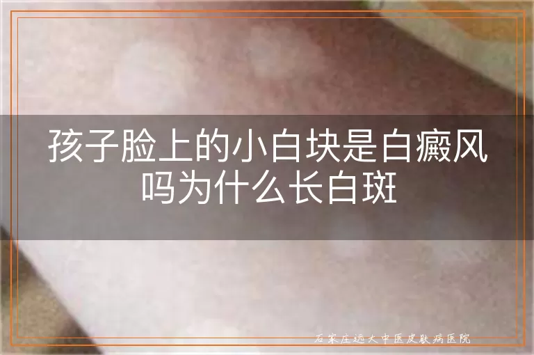 孩子脸上的小白块是白癜风吗为什么长白斑