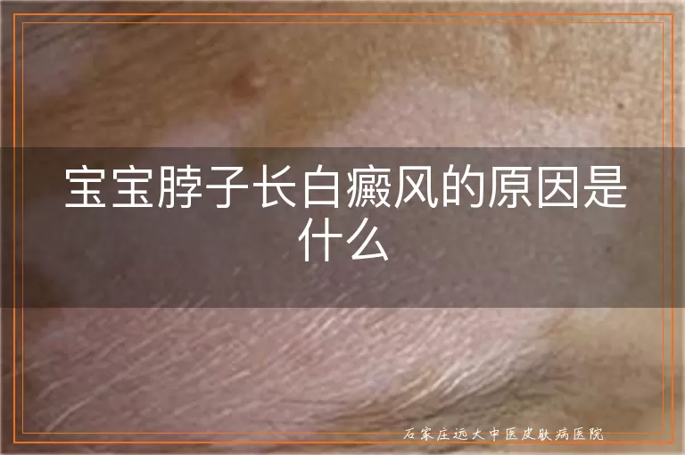 宝宝脖子长白癜风的原因是什么