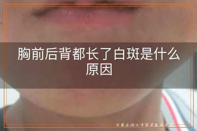 胸前后背都长了白斑是什么原因