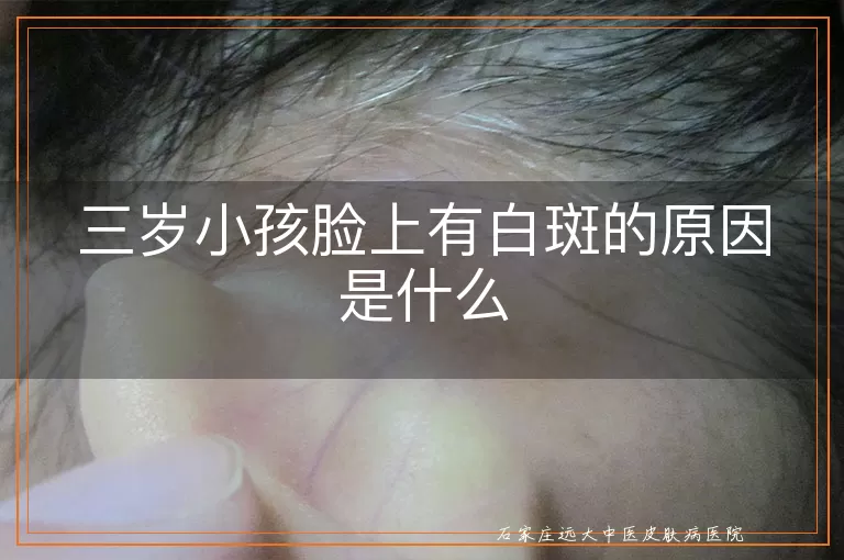三岁小孩脸上有白斑的原因是什么