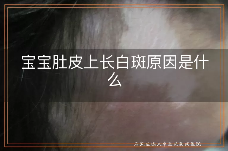 宝宝肚皮上长白斑原因是什么