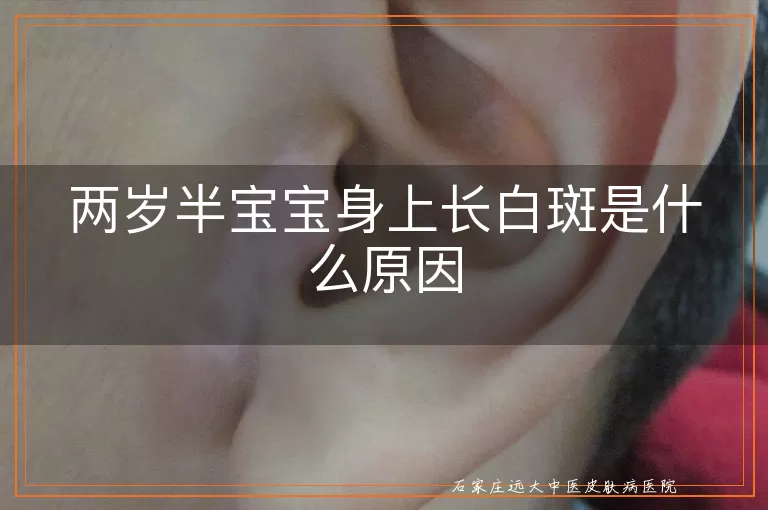 两岁半宝宝身上长白斑是什么原因