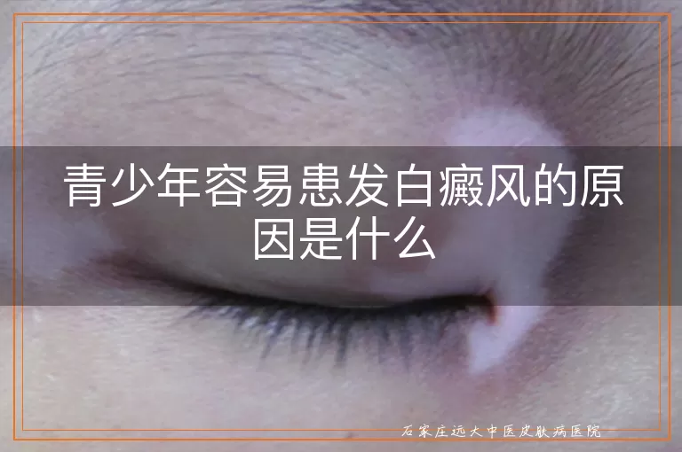 青少年容易患发白癜风的原因是什么
