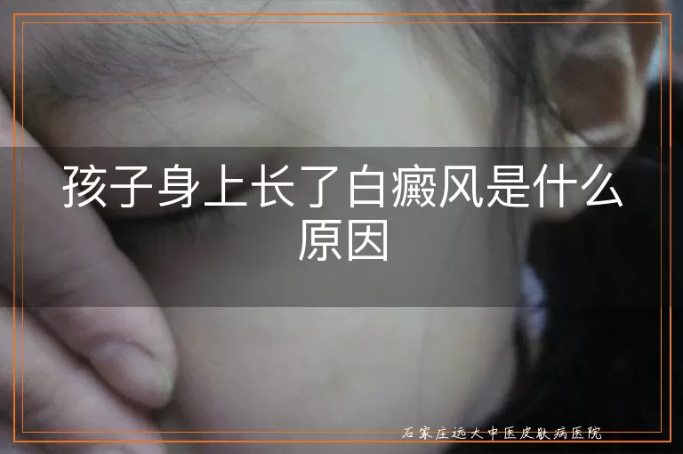 孩子身上长了白癜风是什么原因