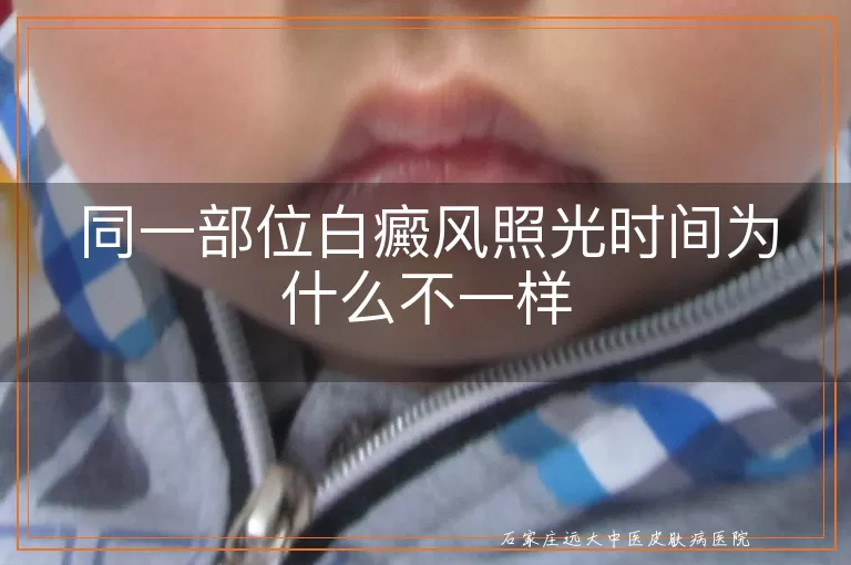 同一部位白癜风照光时间为什么不一样