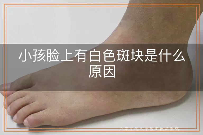 小孩脸上有白色斑块是什么原因