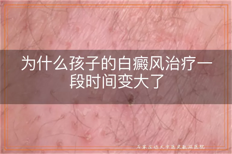 为什么孩子的白癜风治疗一段时间变大了