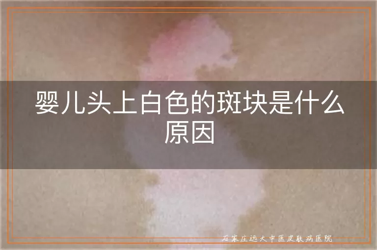婴儿头上白色的斑块是什么原因