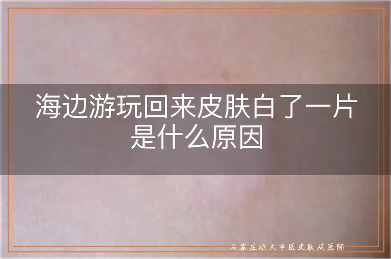 海边游玩回来皮肤白了一片是什么原因