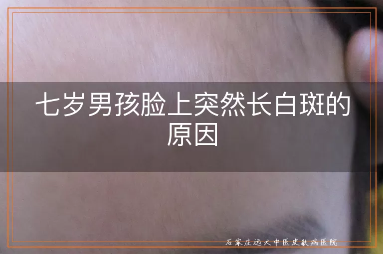 七岁男孩脸上突然长白斑的原因