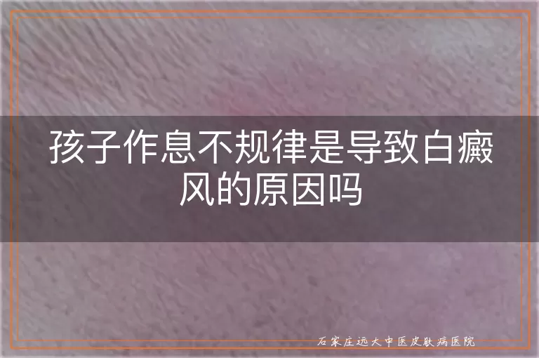 孩子作息不规律是导致白癜风的原因吗