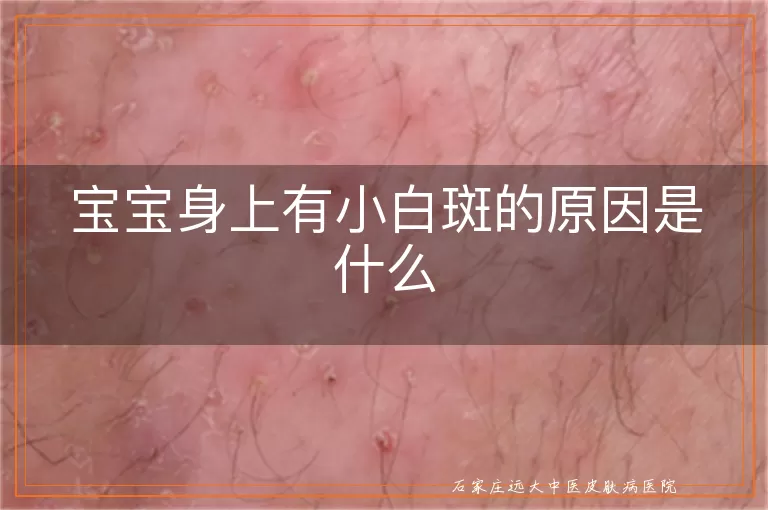 宝宝身上有小白斑的原因是什么