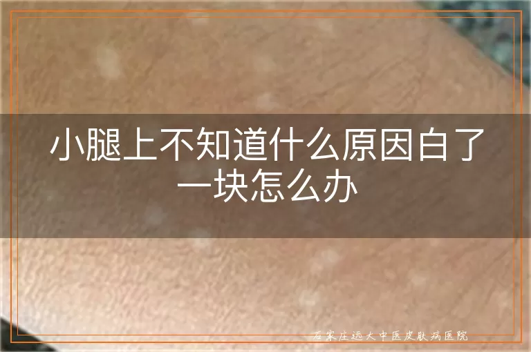 小腿上不知道什么原因白了一块怎么办