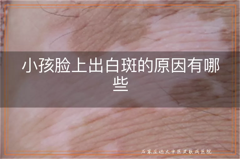 小孩脸上出白斑的原因有哪些