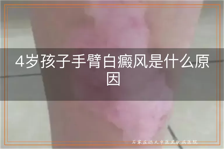 4岁孩子手臂白癜风是什么原因