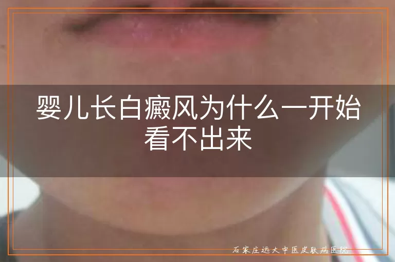 婴儿长白癜风为什么一开始看不出来