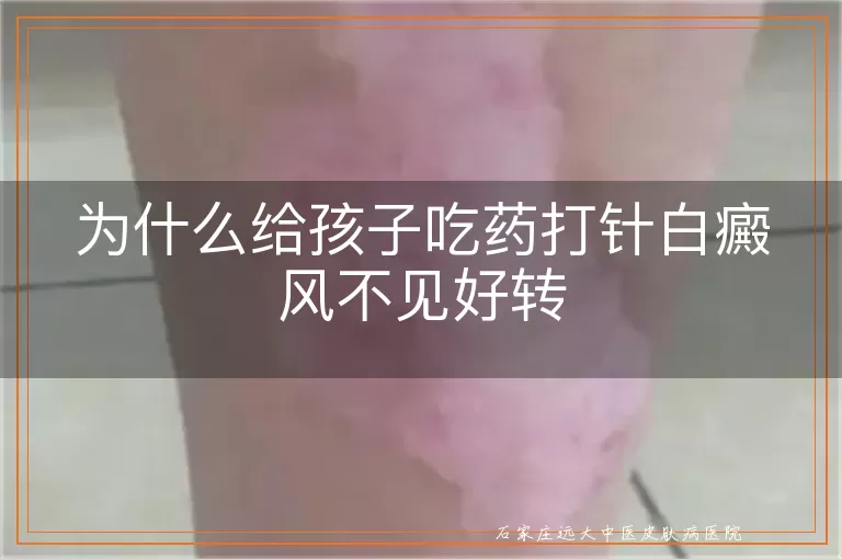 为什么给孩子吃药打针白癜风不见好转