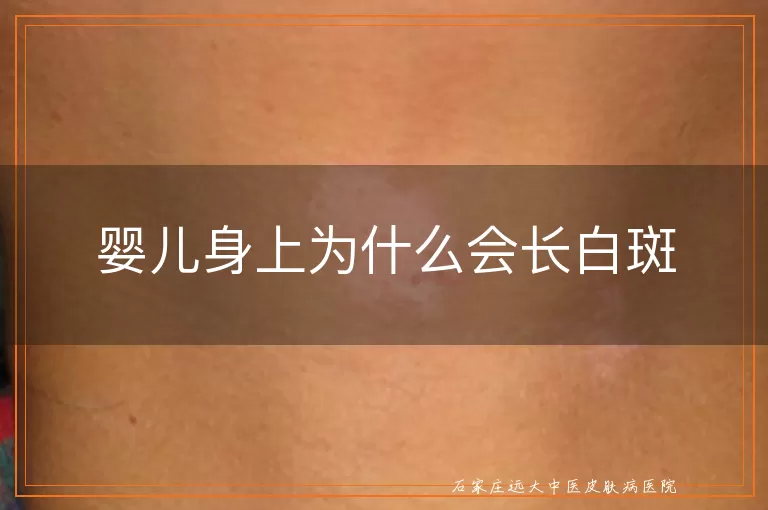 婴儿身上为什么会长白斑