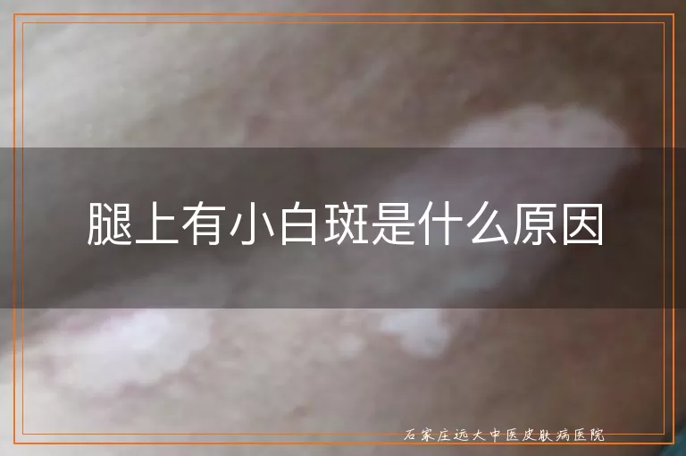 腿上有小白斑是什么原因