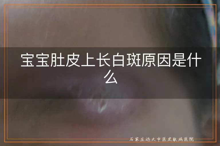 宝宝肚皮上长白斑原因是什么