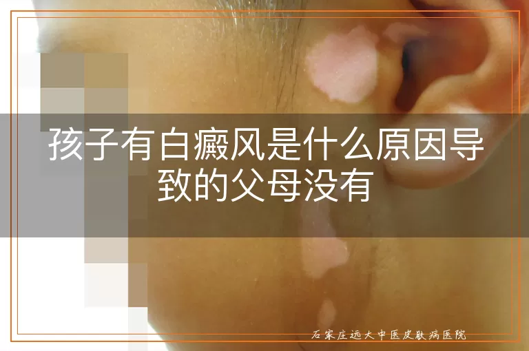 孩子有白癜风是什么原因导致的父母没有