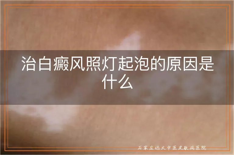 治白癜风照灯起泡的原因是什么