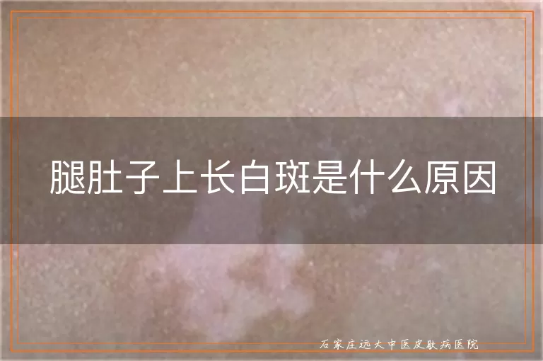 腿肚子上长白斑是什么原因