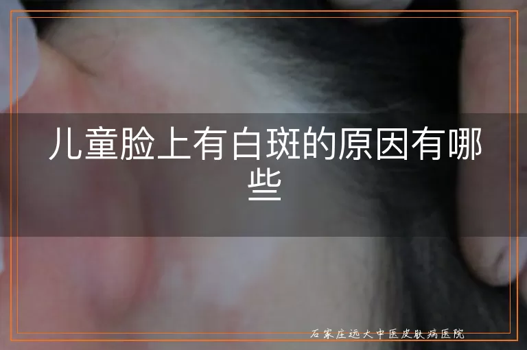 儿童脸上有白斑的原因有哪些