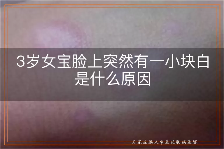 3岁女宝脸上突然有一小块白是什么原因