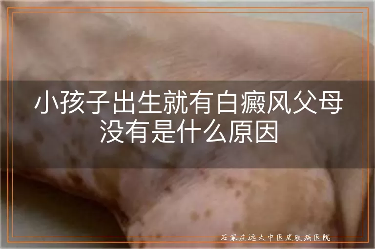 小孩子出生就有白癜风父母没有是什么原因