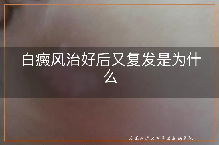 白癜风治好后又复发是为什么