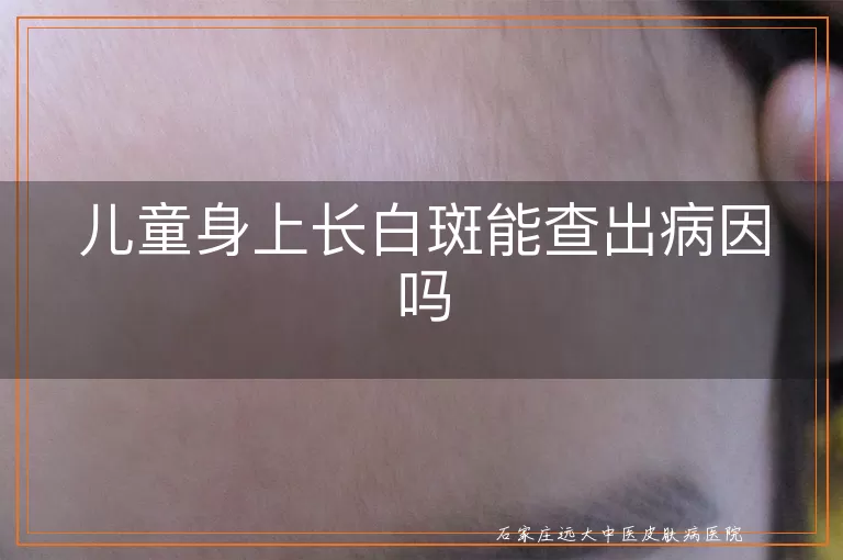 儿童身上长白斑能查出病因吗