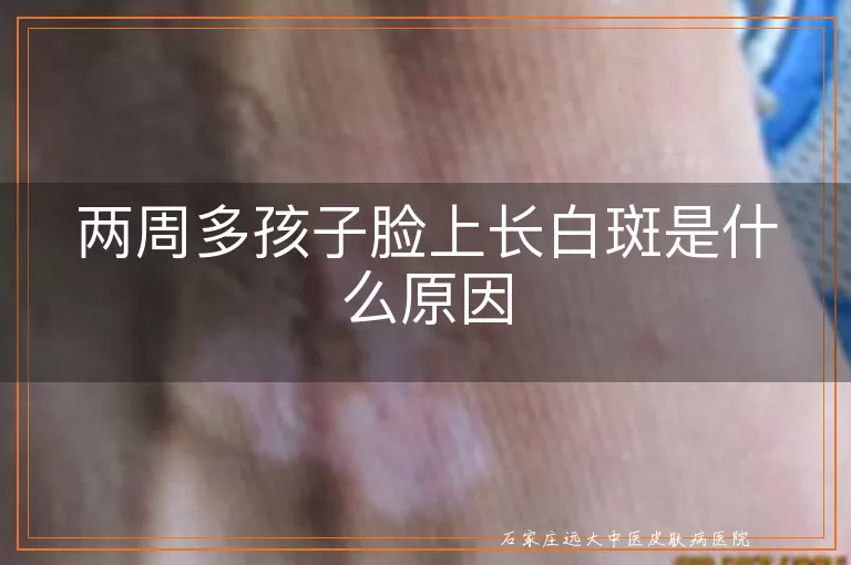 两周多孩子脸上长白斑是什么原因