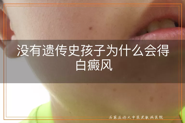 没有遗传史孩子为什么会得白癜风