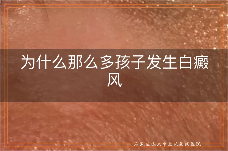 为什么那么多孩子发生白癜风