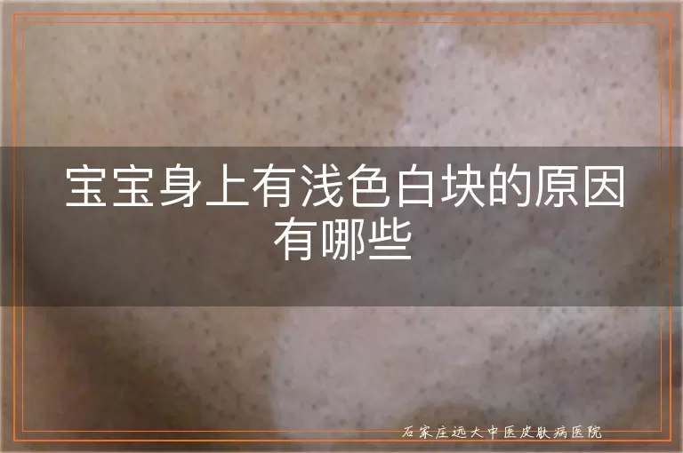 宝宝身上有浅色白块的原因有哪些