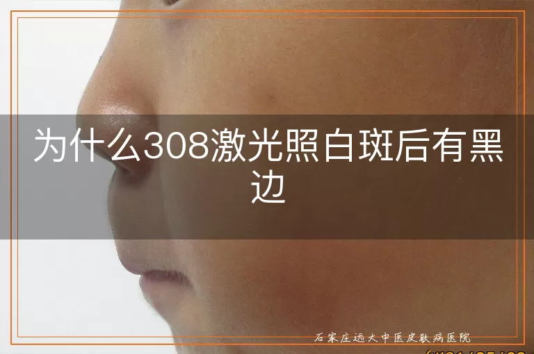 为什么308激光照白斑后有黑边