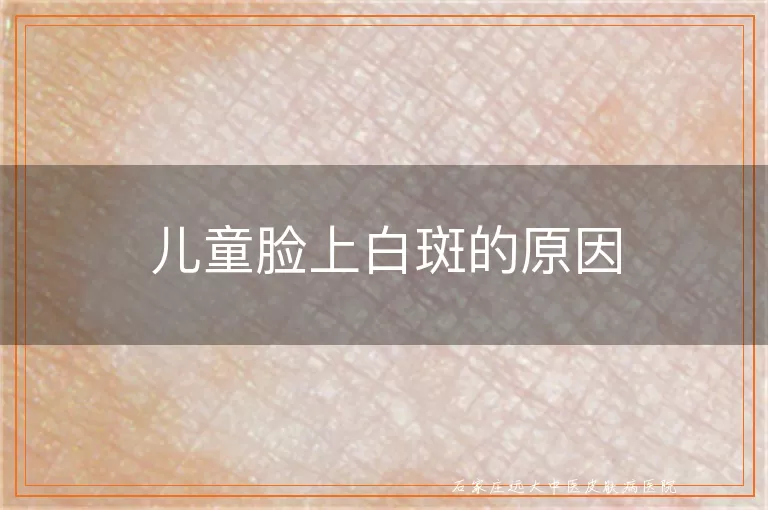 儿童脸上白斑的原因