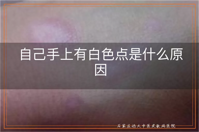 自己手上有白色点是什么原因