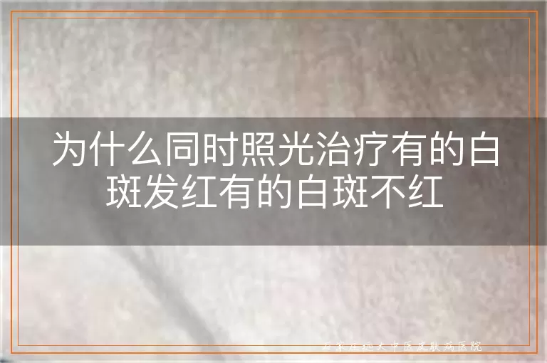 为什么同时照光治疗有的白斑发红有的白斑不红