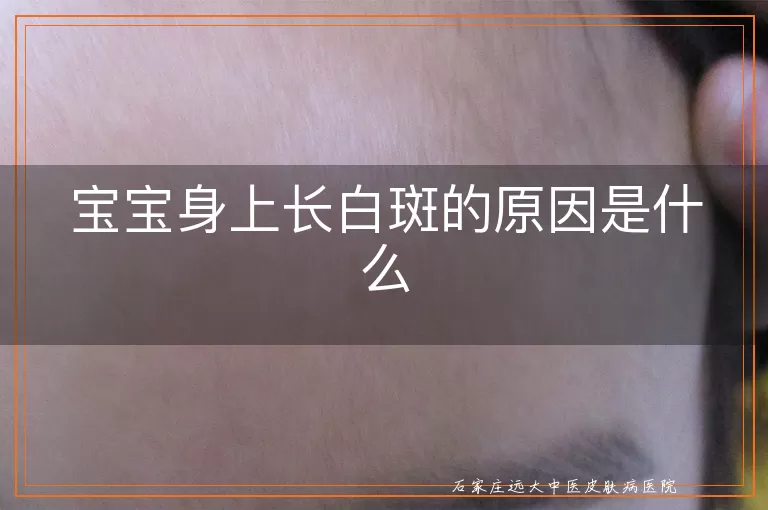 宝宝身上长白斑的原因是什么