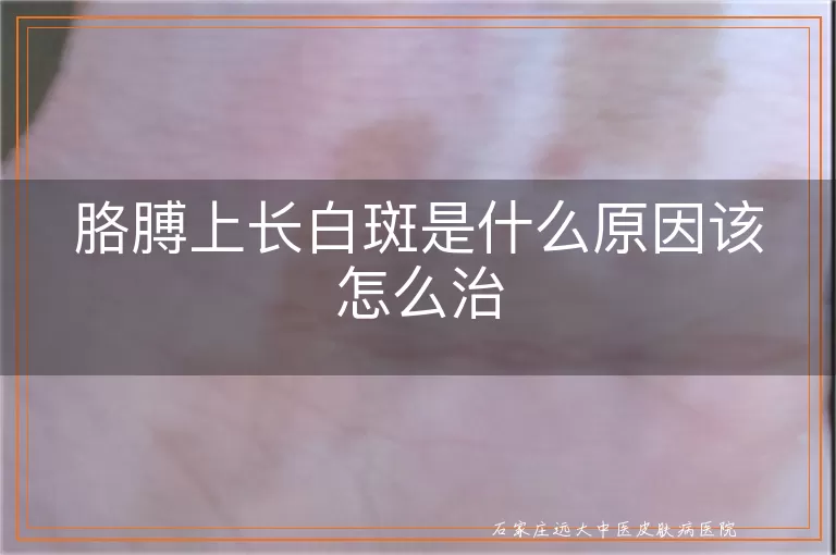 胳膊上长白斑是什么原因该怎么治