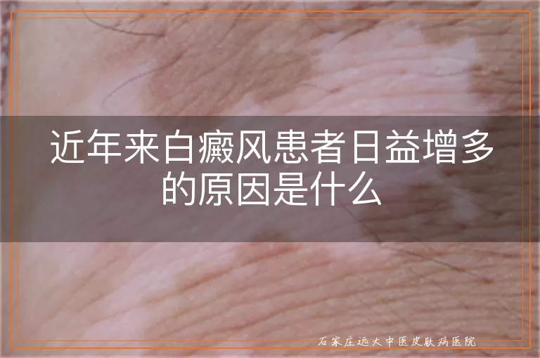 近年来白癜风患者日益增多的原因是什么